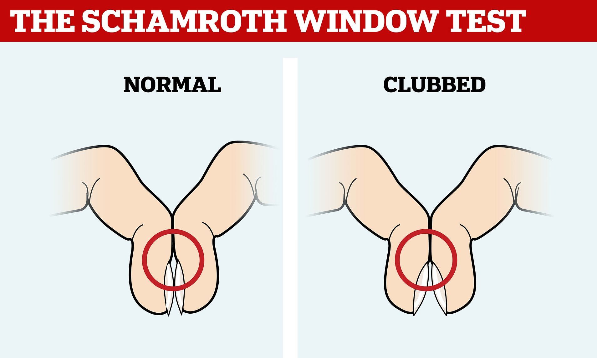 Clubbing Test For Lung Cancer