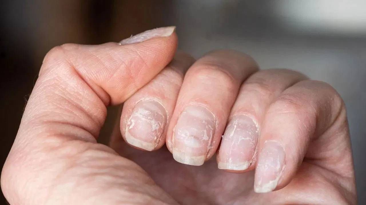 व्हिटॅमिन डी कमी होण्याचे प्रमुख कारण हे कमी सूर्यप्रकाश आहे. यासोबतच खराब आहार हे देखील एक कारण आहे. व्हिटॅमिन डीची कमतरता त्वचेवर अनेक प्रकारे दिसून येते. 