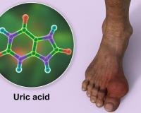 Uric Acid : यूरिक एसिड वाढल्यानंतर काय लक्षणे दिसतात? कशी काळजी घ्यावी ?