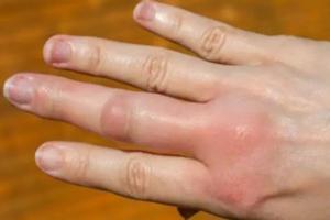 थंडीच्या दिवसात तुमच्याही हातापायांची बोटे सुजतात? तर आतापासूनच घ्या अशी काळजी